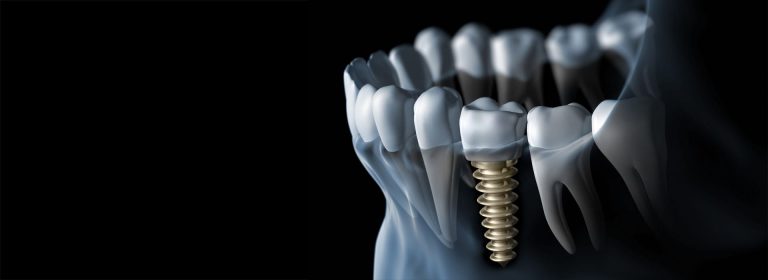 İmplant 5 implant dis caddedisklinik