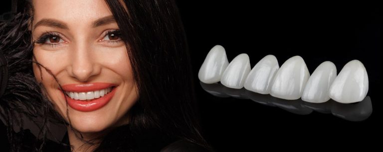 Gülüş Tasarımı (Hollywood Smile) 1 ce sunt fatele dentare 2